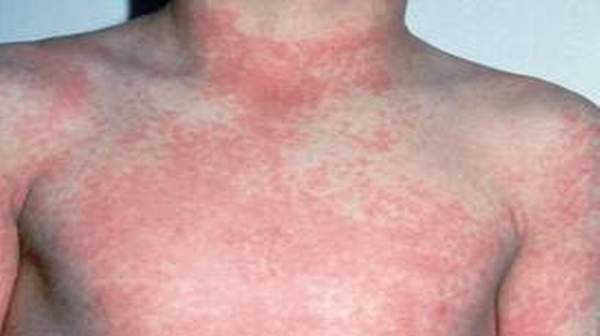 streptococcal rashes