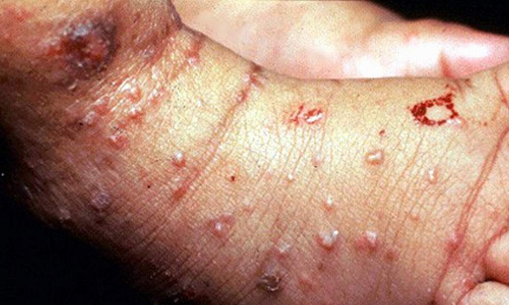 What is a scabies rash?