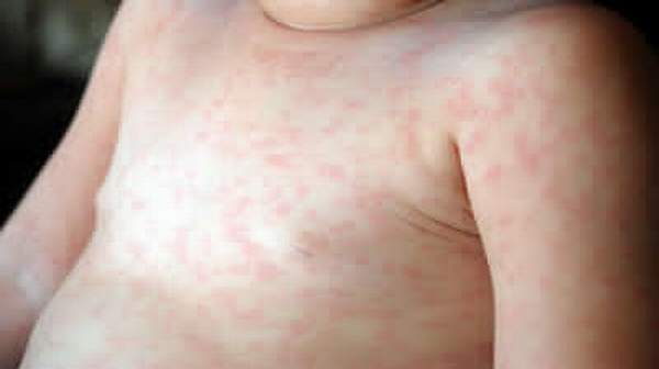 Roseola Images - Photos - Pictures