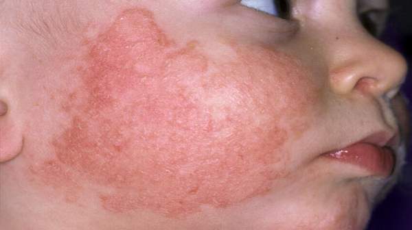 Common Childhood Skin Problems | Health Digest