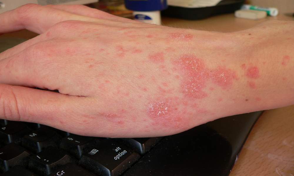 Scabies rash Look Like & Causes10