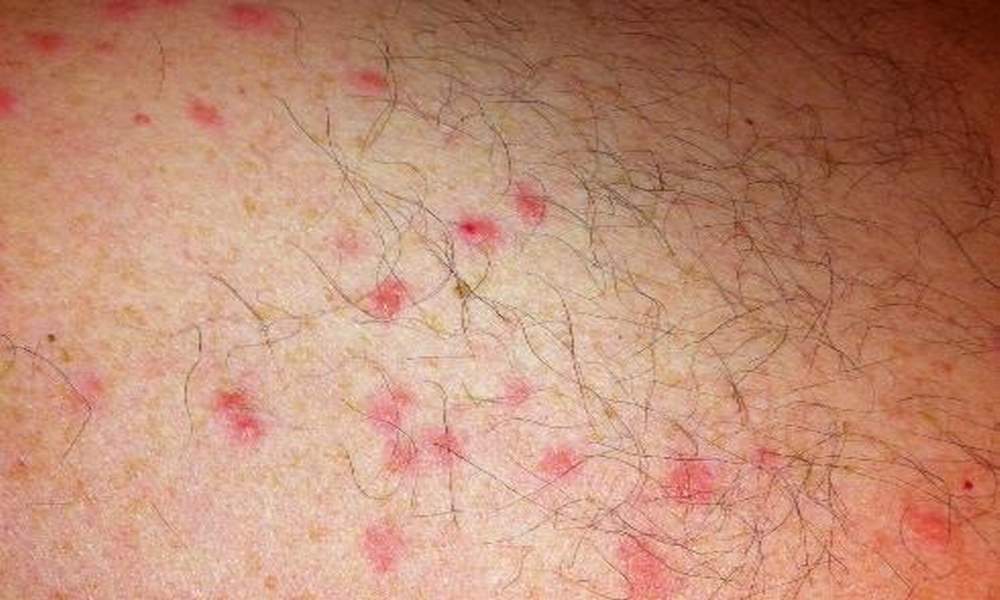 Scabies rash Look Like & Causes7